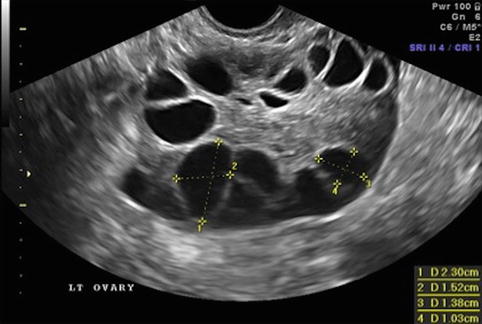 2d Ultrasound In Follicle Monitoring For Art Radiology Key