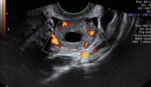 2d Ultrasound In Follicle Monitoring For Art Radiology Key