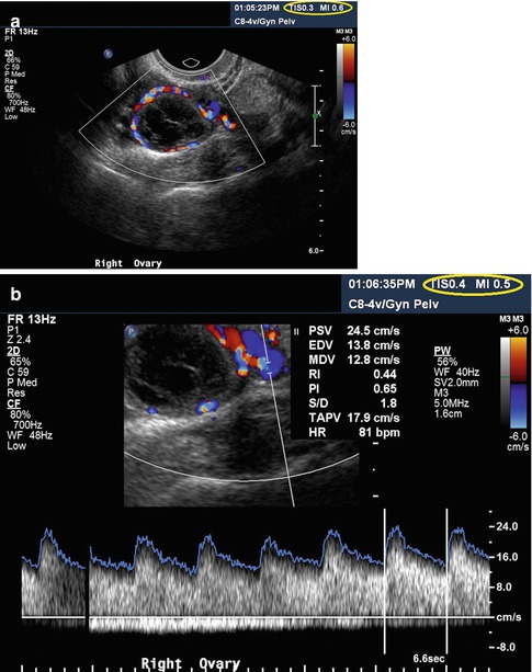 Ultrasound In Reproductive Medicine Is It Safe Radiology Key My Xxx Hot Girl 