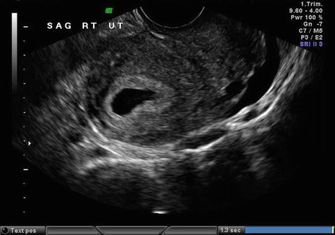 ectopic pregnancy ultrasound