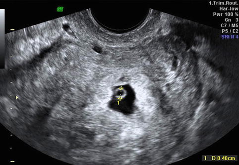 Ectopic Pregnancy Ultrasound 8 Weeks