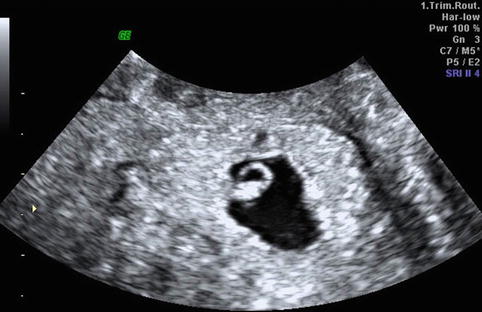 ectopic pregnancy ultrasound