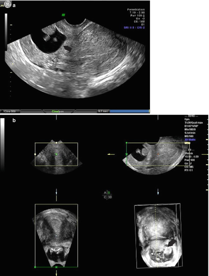 Ultrasound Evaluation Of Ectopic Pregnancy Radiology Key 