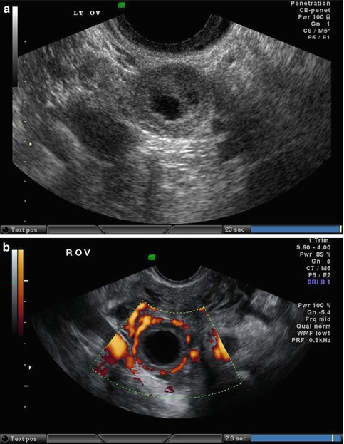 ovarian ectopic pregnancy ultrasound