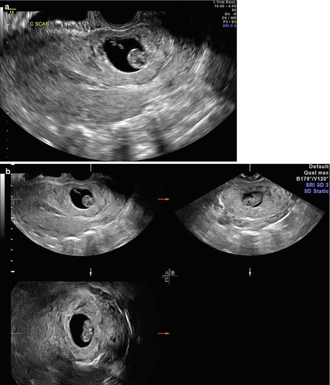 Ultrasound Evaluation Of Ectopic Pregnancy Radiology Key