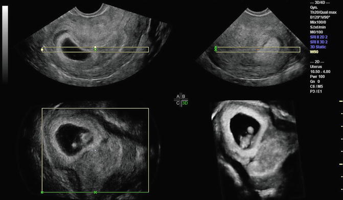 Ultrasound Evaluation Of Ectopic Pregnancy Radiology Key 