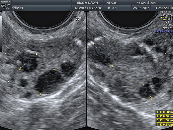 The Normal Ovary (Changes in the Menstrual Cycle) | Radiology Key