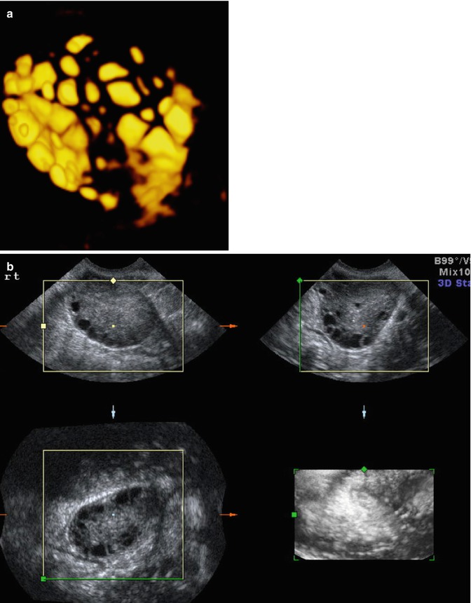 Corpus luteum, Radiology Reference Article