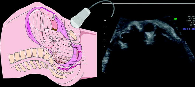 Head Rotation in Labor and Intrapartum Sonography ...