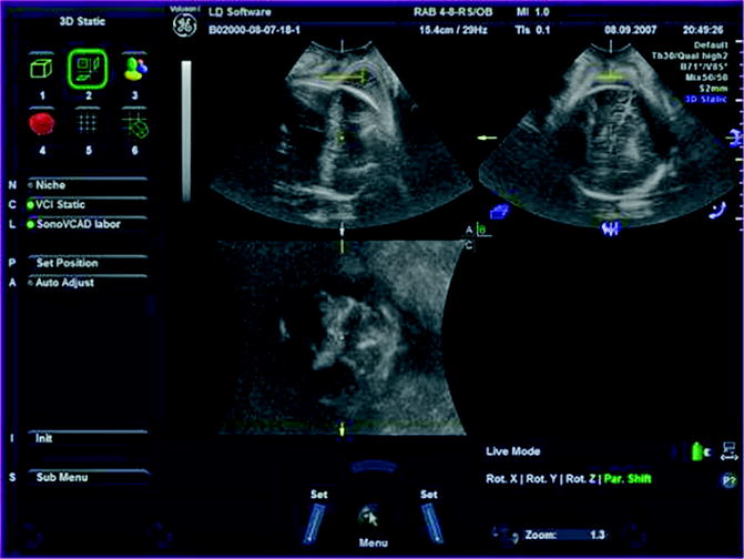 The Angle of Progression: An Objective Assessment of Fetal Head Descent ...