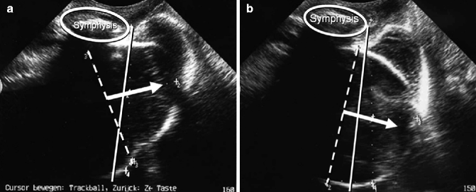 Intrapartum Translabial Ultrasound Itu To Assess Birth Progress