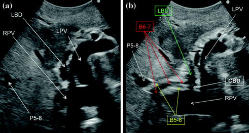 Exploring the Liver by Ultrasound Along its Anatomy | Radiology Key