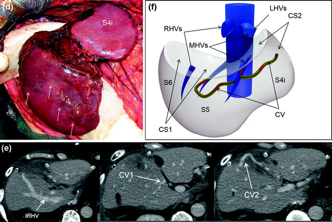 Planning of the Surgical Strategy | Radiology Key
