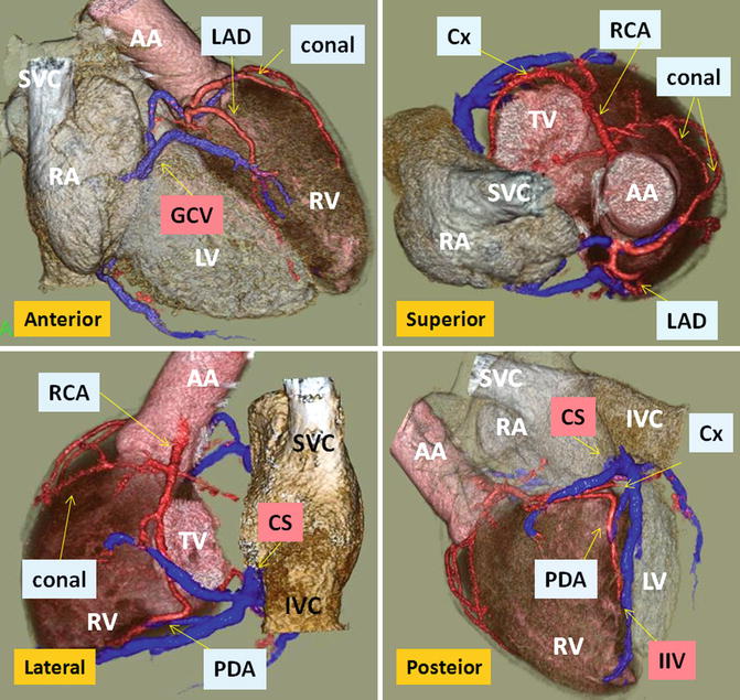 Transposition Of The Great Arteries Radiology Key