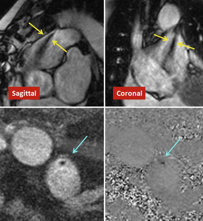 Cardiac Shunts ASD, VSD, PDA Radiology Key