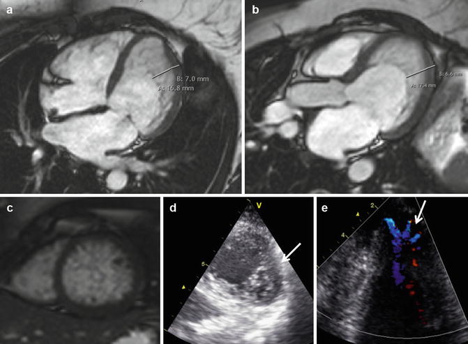 Hypertrophic Cardiomyopathy | Radiology Key