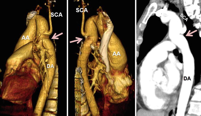 interrupted aortic arch in newborn
