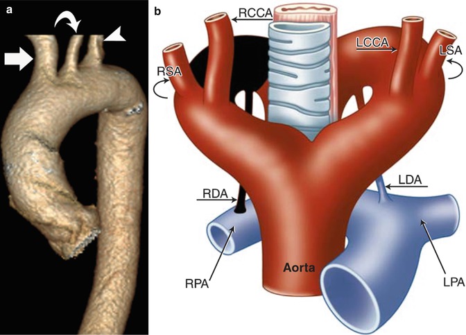 Aortic Arch Anomalies Radiology Key
