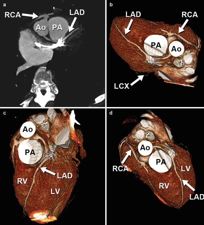 Coronary Artery Anomalies | Radiology Key