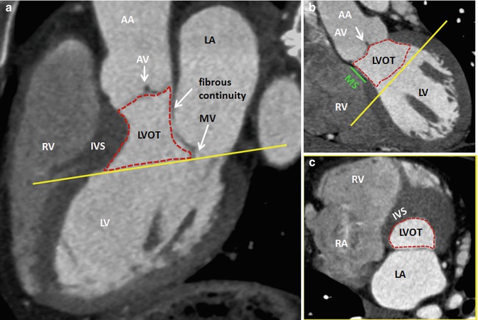 Left Ventricular Outflow Tract Radiology Key