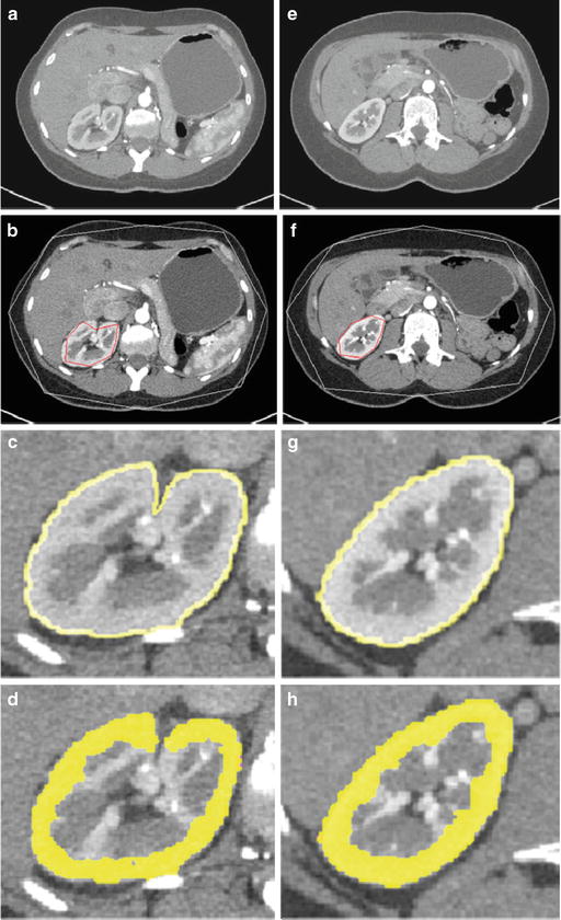 Cortex Segmentation on Computed Tomography | Radiology Key