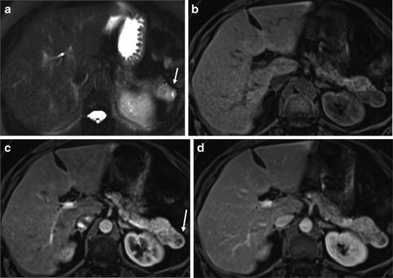 Resonance Imaging Of Adenocarcinoma Of The Pancreas | Radiology Key