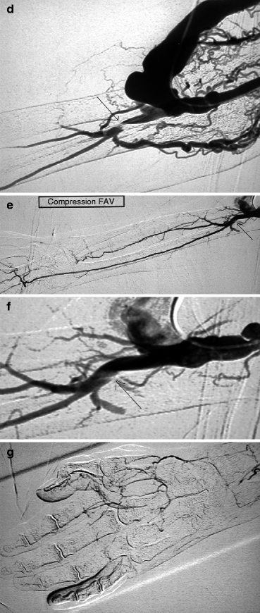 hand-ischemia-radiology-key