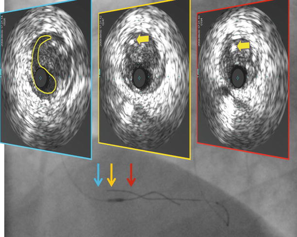 Guidewires And Angioplasty Balloons: The Primer | Radiology Key