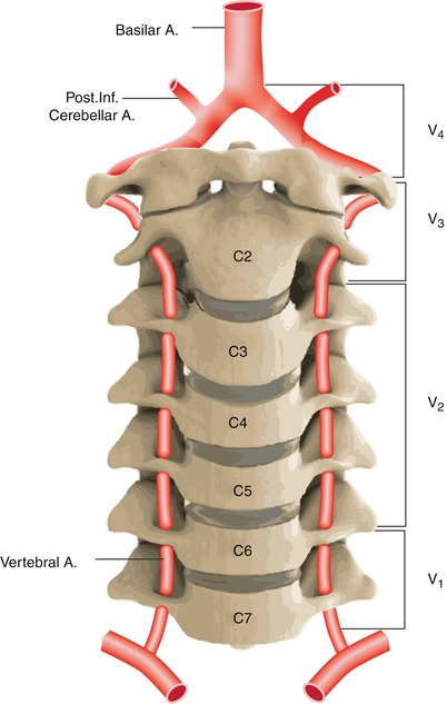 Percutaneous Management of Carotid and Vertebral Artery Disease ...