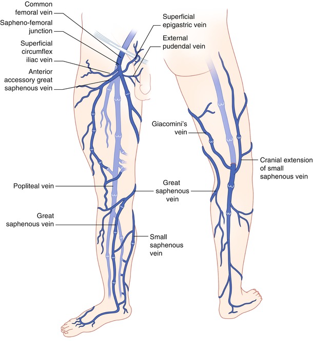 Venous Thromboembolic Disease | Radiology Key