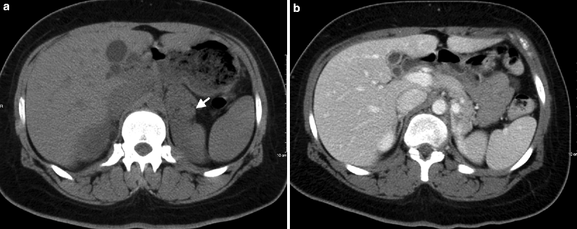 Adrenal Neoplasms | Radiology Key