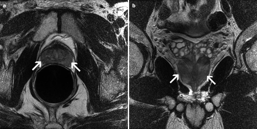 prostatitis mri findings gyakorlat otthon a prostatitis