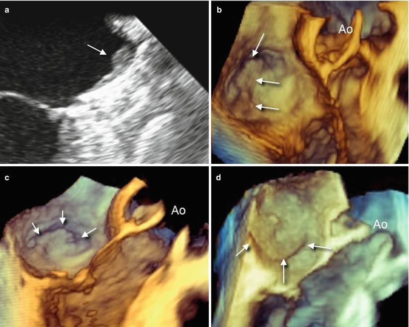 Percutaneous Closure Of The Left Atrial Appendage | Radiology Key