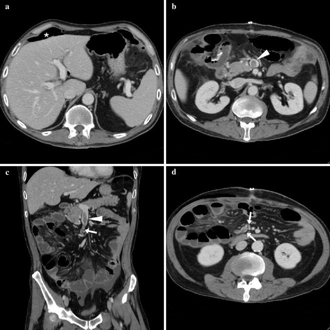 Vascular Complications Of Ulcerative Colitis Radiology Key 9358