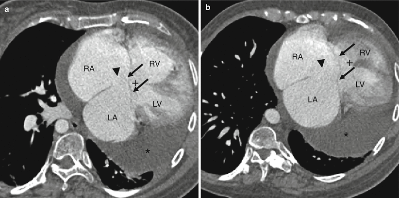 sinus venosus asd