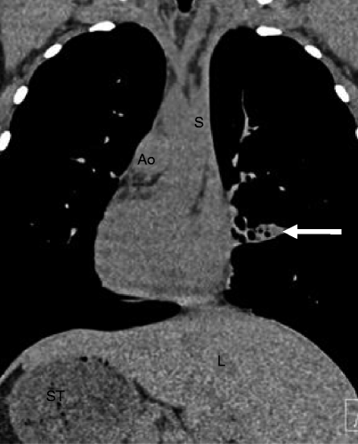 Damus–Kaye–Stansel Procedure | Radiology Key