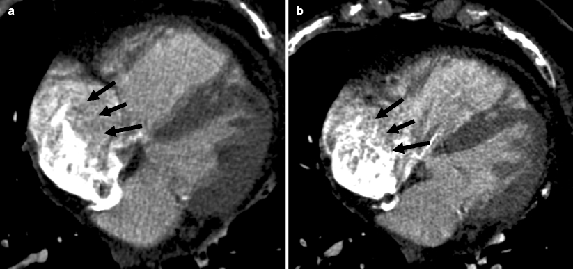 Normal Anatomic Variants And Imaging Artifacts Mimicking Pathology