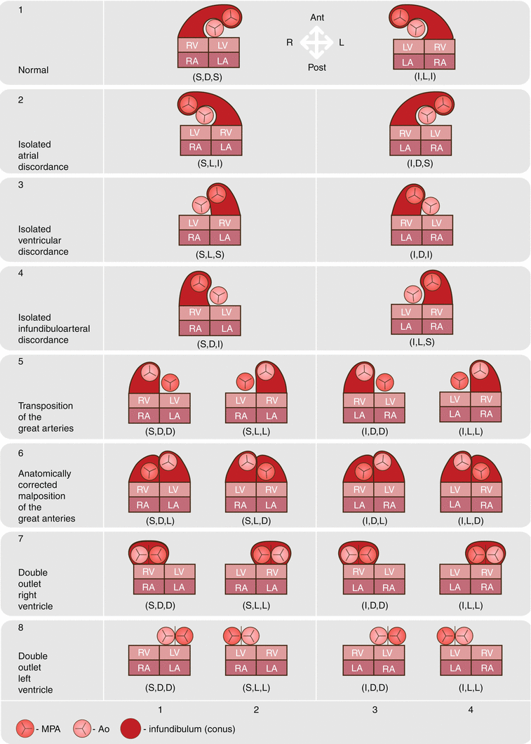 Basic Nomenclature In Adult Congenital Heart Disease Radiology Key 4461