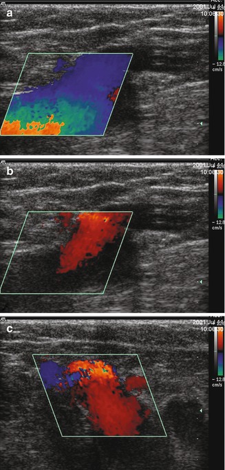 ultrasound for varicose veins