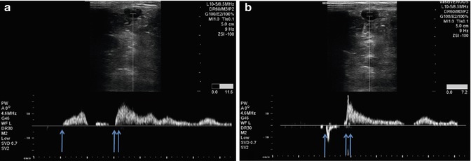 Examination Of The Small Saphenous Vein Radiology Key