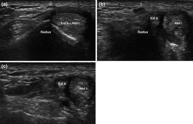 Wartenberg’s Syndrome | Radiology Key