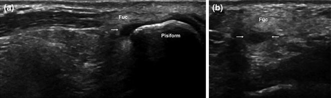 Guyon’s Canal | Radiology Key