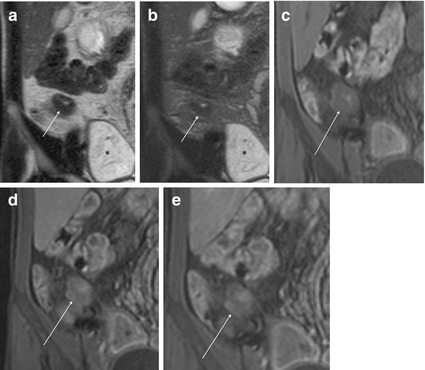 MR Findings in Crohn’s Disease | Radiology Key