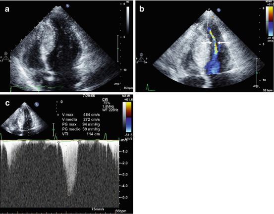 Basic Echocardiography In Hypertrophic Cardiomyopathy Radiology Key