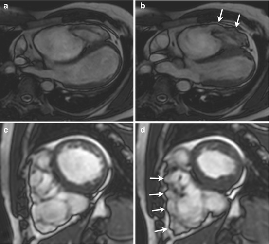 The uniqueness of cardiac magnetic resonance imaging in arrhythmogenic  right ventricular cardiomyopathy