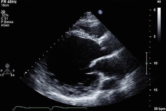 Echocardiography findings. Echocardiography shows global hypokinesia on