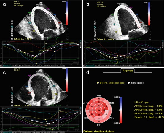 Advanced Echocardiographic Technologies In Dilated Cardiomyopathy Radiology Key 