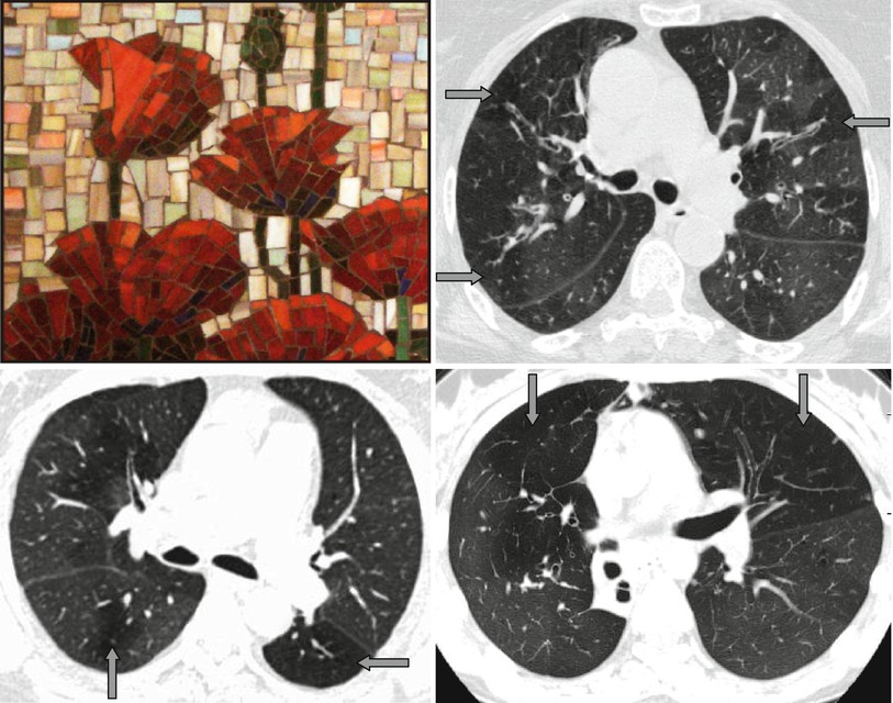 Perfusion or Mosaic Lung Sign Radiology Key