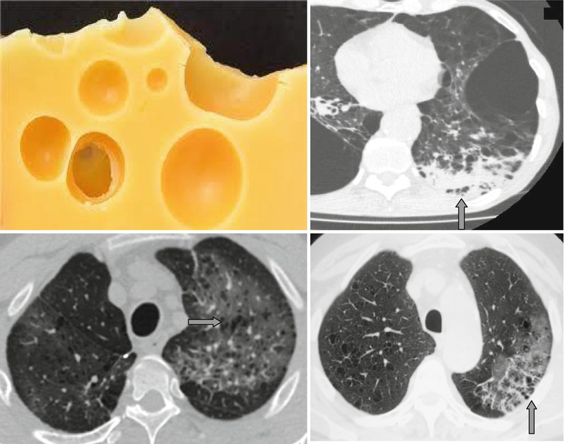 Cheese Appearance | Radiology Key