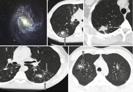 Sign or Beak Sign | Radiology Key